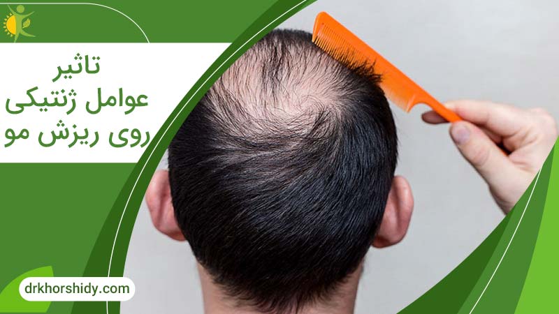 تاثیر عوامل ژنتیکی روی ریزش مو