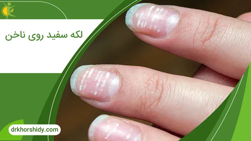 لکه سفید روی ناخن