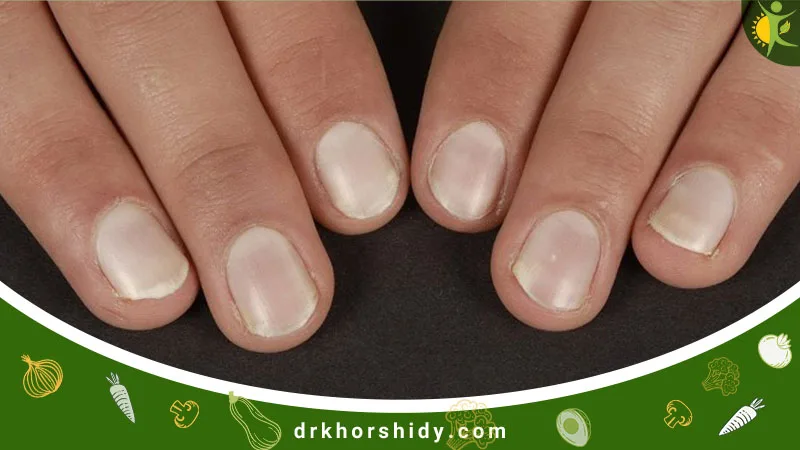 سفید شدن ناخن