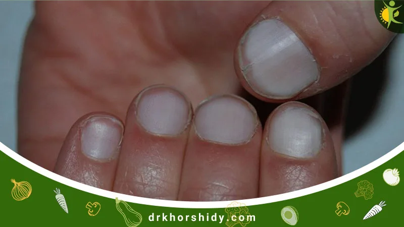 سفید شدن کامل ناخنهای دست