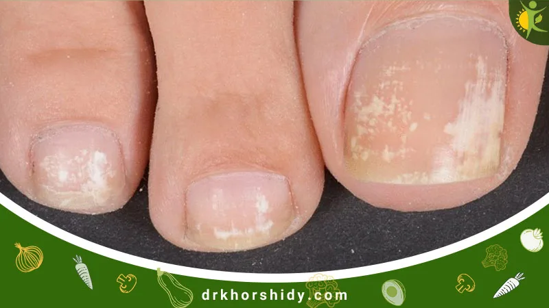 لکه سفید روی ناخن های پا